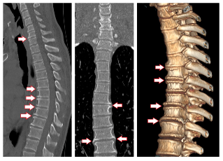 symptoms of degenerative disc disease