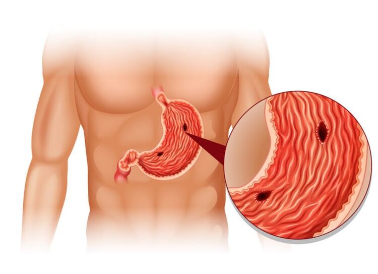 ulcer as a cause of pain under the left shoulder blade behind