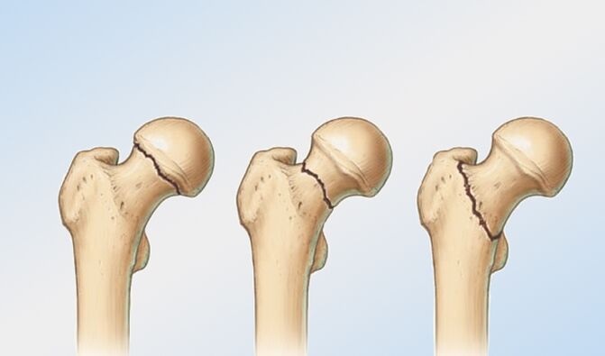 hip fracture