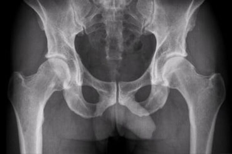 x-ray of the hip joint for pain