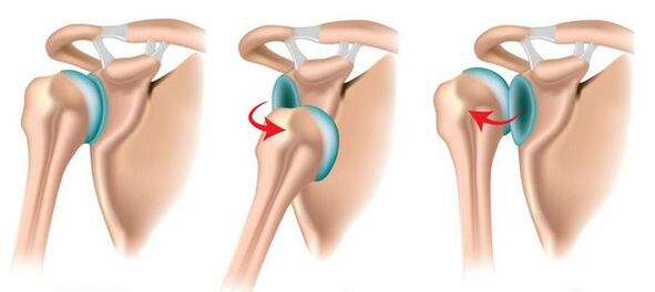 Anterior and posterior dislocation of the shoulder joint, causing the development of arthrosis