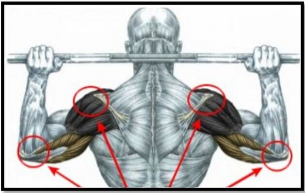 Shoulder and elbow muscle strain is one of the causes of shoulder joint arthrosis