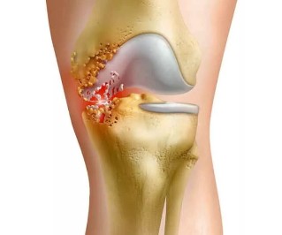 Inflammation of the joints