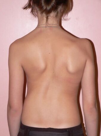 Scoliosis 2 degrees