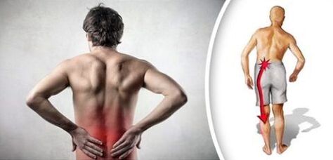 Syndrome pain with lumbar osteochondrose radiates to their feet