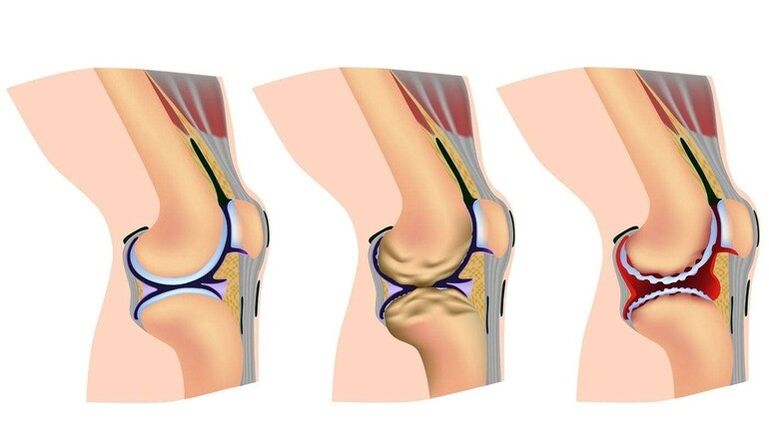Deformation phases in the knee joint for arthrosis