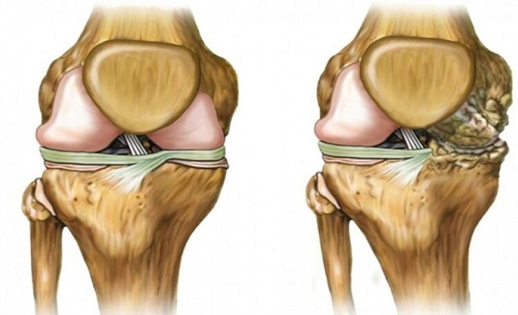 Healthy and affected by an arthrosis of the wrist