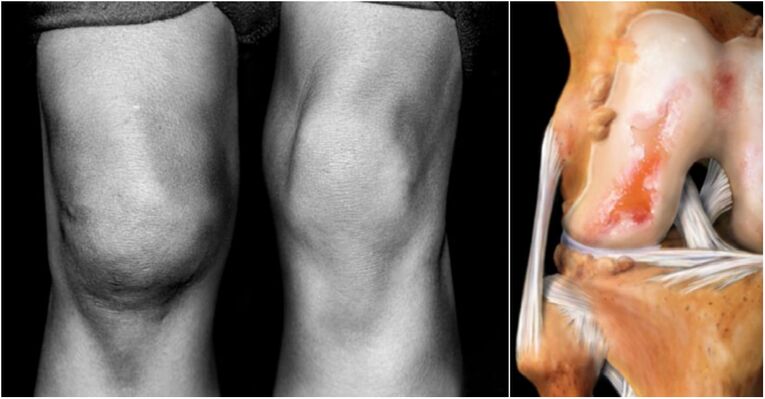 Knee wrist arthrosis and painful joint