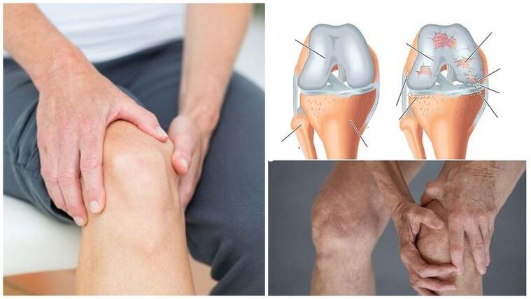 Symptom Heels Knee Arthrosis Knee Hand