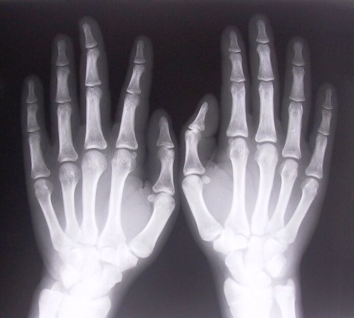 X-ray as a way of diagnosing pain in finger joints