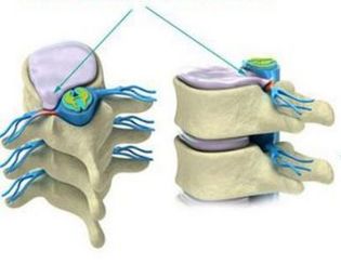 herniation